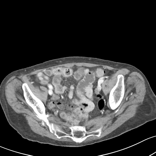 Acute cholecystitis with contained perforation (Radiopaedia 47328-51907 Axial C+ portal venous phase 59).png