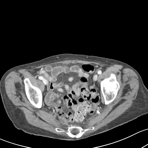 Acute cholecystitis with contained perforation (Radiopaedia 47328-51907 Axial C+ portal venous phase 62).png