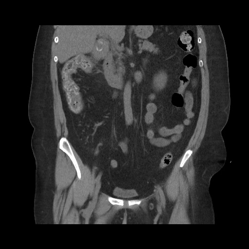 Acute cholecystitis with tensile fundus sign (Radiopaedia 71394-81723 Coronal non-contrast 64).jpg