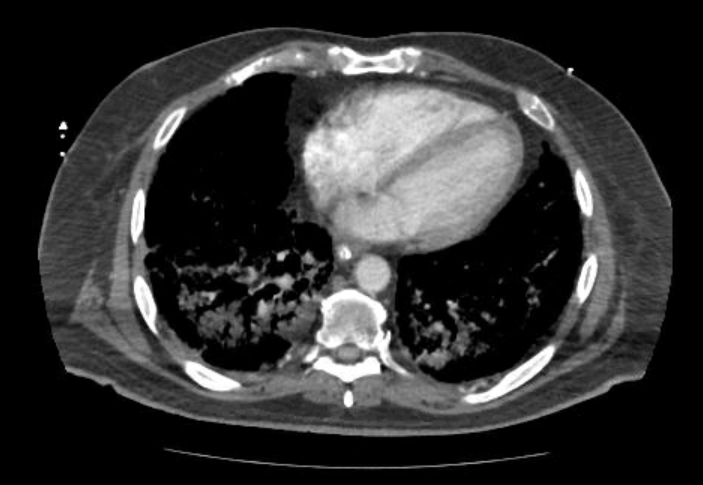 Acute cor pulmonale (ultrasound) (Radiopaedia 83508-98818 Axial C+ CTPA 54).jpg