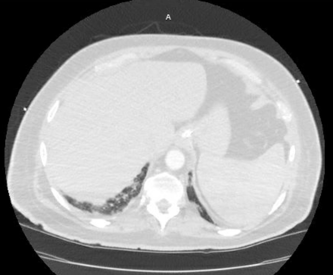 Acute cor pulmonale (ultrasound) (Radiopaedia 83508-98818 Axial lung window 82).jpg