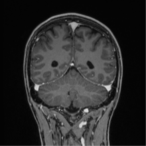Acute disseminated encephalomyelitis (ADEM) (Radiopaedia 65319-74349 Coronal T1 C+ 4).png
