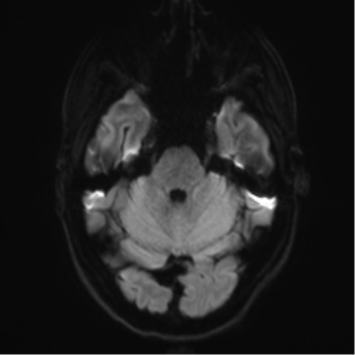 File:Acute disseminated encephalomyelitis (ADEM) (Radiopaedia 65319-74350 Axial DWI 7).png