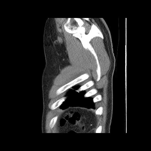 File:Acute epicardial fat necrosis (Radiopaedia 42327-45440 Sagittal C+ CTPA 65).jpg