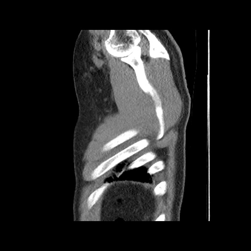 File:Acute epicardial fat necrosis (Radiopaedia 42327-45440 Sagittal C+ CTPA 66).jpg