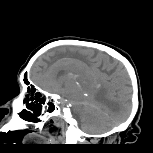 File:Acute hemorrhagic stroke (Radiopaedia 17507-17223 Sagittal non-contrast 27).jpg
