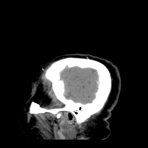 File:Acute hemorrhagic stroke (Radiopaedia 17507-17223 Sagittal non-contrast 42).jpg