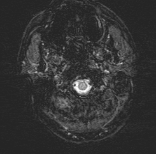 Acute ischemic stroke - posterior circulation territory (Radiopaedia 77670-89880 Axial SWI 3).jpg