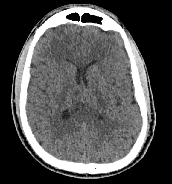 Acute ischemic stroke - posterior circulation territory (Radiopaedia 77670-89881 non-contrast 51).jpg