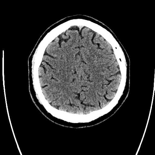 Acute left middle cerebral artery territory ischemic stroke (Radiopaedia 35688-37223 Axial non-contrast 62).png