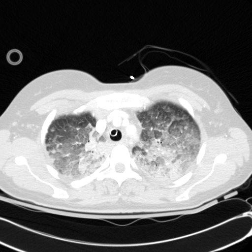 Acute myocardial infarction in CT (Radiopaedia 39947-42415 Axial lung window 27).jpg