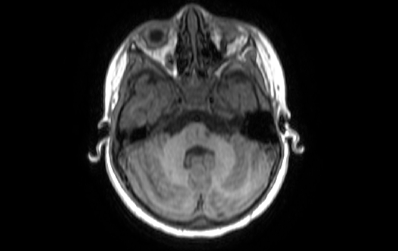 Acute necrotizing encephalitis of childhood (Radiopaedia 67356-76737 Axial T1 73).jpg