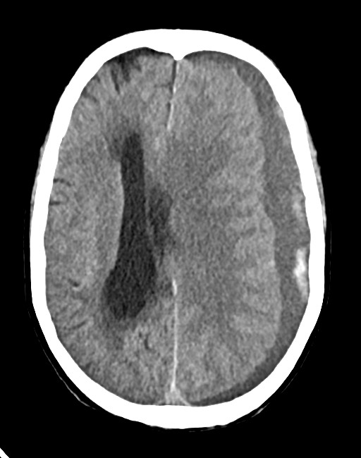 Acute on chronic subdural hematoma (Radiopaedia 74814-85823 Axial non-contrast 51).jpg