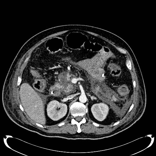 Acute pancreatic necrosis (Radiopaedia 13560-18500 Axial C+ portal venous phase 58).jpg