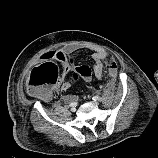 File:Acute pancreatic necrosis (Radiopaedia 13560-18501 Axial C+ portal venous phase 107).jpg