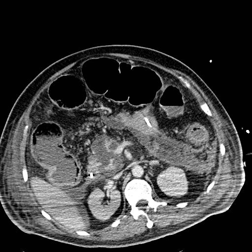 Acute pancreatic necrosis (Radiopaedia 13560-18501 Axial C+ portal venous phase 52).jpg