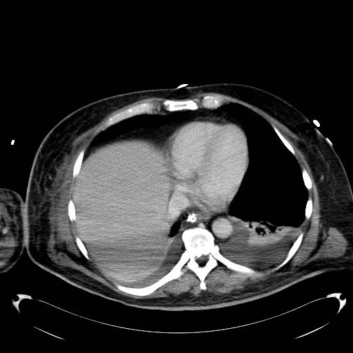 Acute pancreatic necrosis (Radiopaedia 13560-18503 Axial C+ portal venous phase 2).jpg