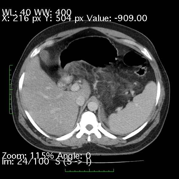 Acute pancreatitis (Radiopaedia 34043-35276 Axial C+ portal venous phase 24).jpg