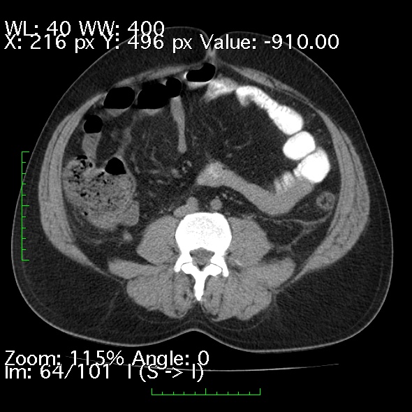 Acute pancreatitis (Radiopaedia 34043-35276 Axial non-contrast 64).jpg