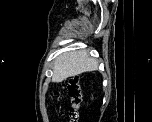 Acute pancreatitis (Radiopaedia 85146-100701 Sagittal C+ portal venous phase 7).jpg