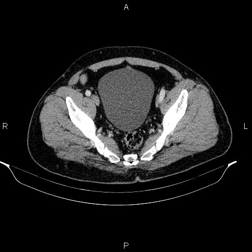 Acute pancreatitis (Radiopaedia 85390-101010 Axial C+ portal venous phase 93).jpg