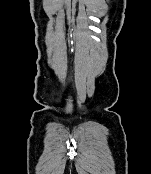 Acute pancreatitis (Radiopaedia 87428-103757 Coronal C+ portal venous phase 88).jpg
