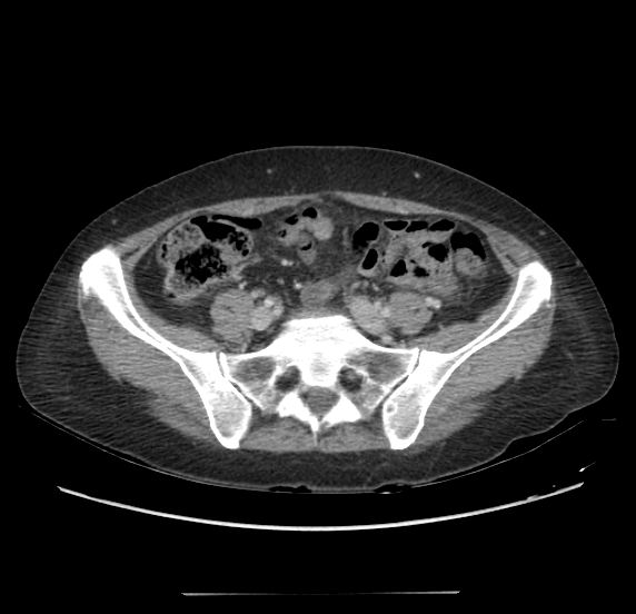 File:Acute pancreatitis - Balthazar E - post ERCP (Radiopaedia 27562-27772 Axial C+ portal venous phase 55).png