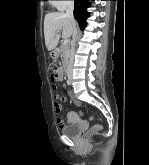 Acute pancreatitis - Balthazar E - post ERCP (Radiopaedia 27562-27772 Sagittal C+ portal venous phase 61).png