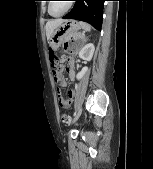Acute pancreatitis - Balthazar E - post ERCP (Radiopaedia 27562-27772 Sagittal C+ portal venous phase 92).png