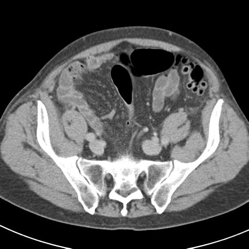 Acute pancreatitis and walled-off necrosis (Radiopaedia 29888-30403 Axial C+ delayed 65).jpg