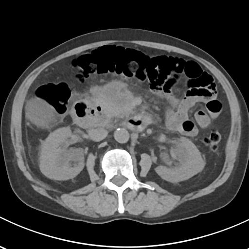 File:Acute pancreatitis and walled-off necrosis (Radiopaedia 29888-30404 Axial non-contrast 34).jpg