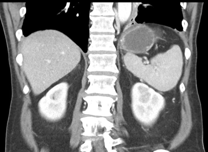 Acute pancreatitis and walled-off necrosis (Radiopaedia 29888-30404 Coronal C+ portal venous phase 39).jpg