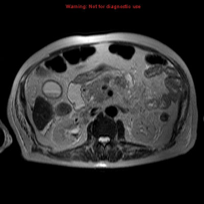File:Acute pancreatitis with incidental pancreatic lipoma (Radiopaedia 10190-10732 Axial T2 6).jpg