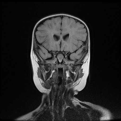 File:Acute phase of hemiconvulsion-hemiplegia epilepsy syndrome (Radiopaedia 29309-29745 Coronal FLAIR 8).jpg