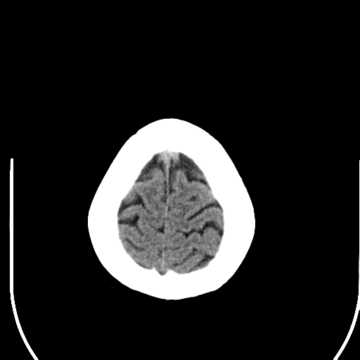 File:Acute pontine infarct from vertebral artery dissection (Radiopaedia 34111-35369 Axial non-contrast 28).png
