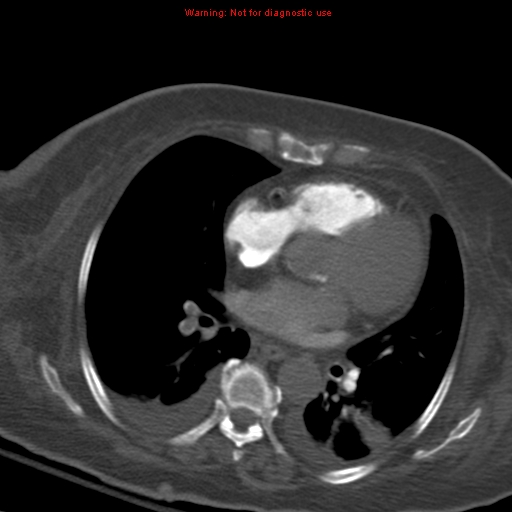 Acute pulmonary embolism (Radiopaedia 13286-13289 Axial C+ CTPA 38).jpg