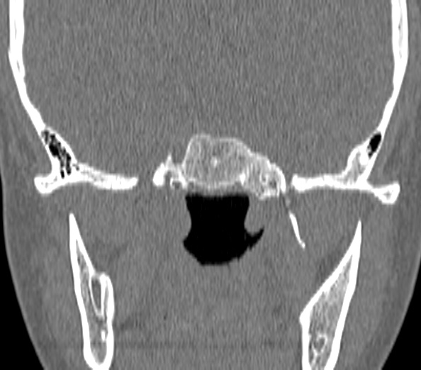 File:Acute sinusitis (Radiopaedia 40564-43158 Coronal bone window 43).jpg
