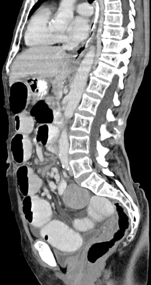 Acute small bowel (ileal) volvulus (Radiopaedia 71740-82139 Sagittal C+ portal venous phase 88).jpg