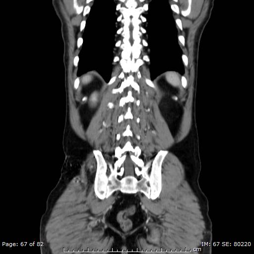 Acute superior mesenteric artery occlusion (Radiopaedia 43636-47060 Coronal C+ portal venous phase 52).jpg