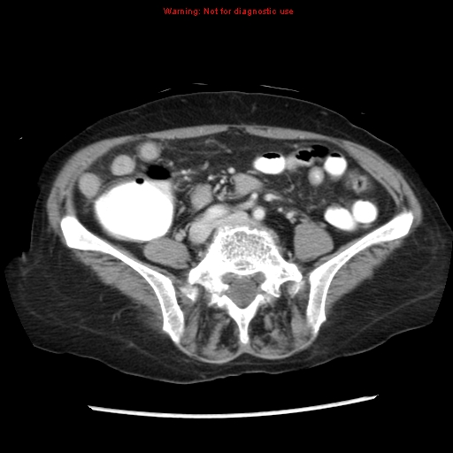 Adenocarcinoma of the colon (Radiopaedia 8191-9039 Axial liver window 49).jpg