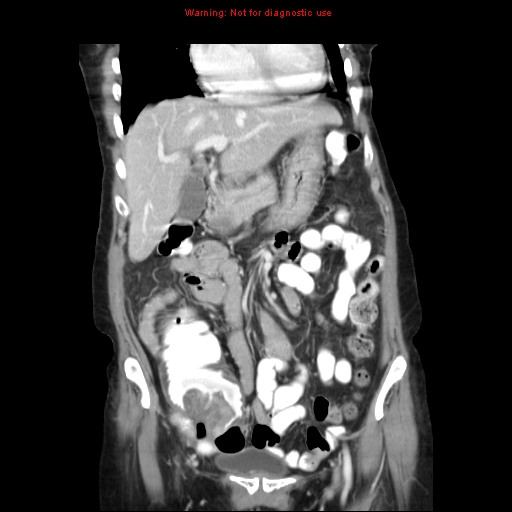 File:Adenocarcinoma of the colon (Radiopaedia 8191-9039 Coronal liver window 16).jpg