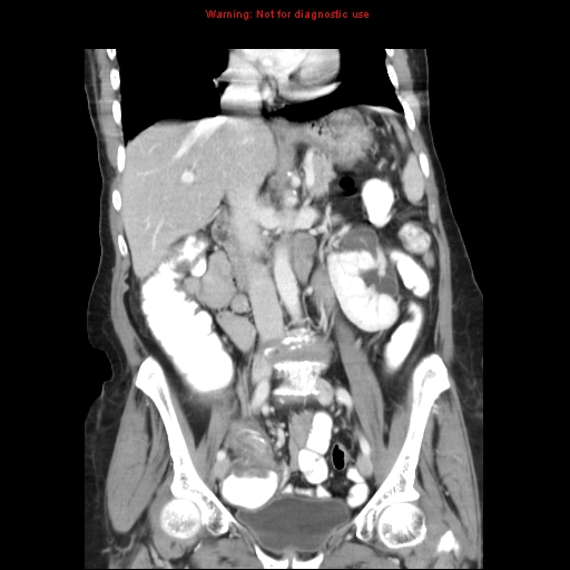 File:Adenocarcinoma of the colon (Radiopaedia 8191-9039 Coronal liver window 23).jpg
