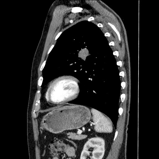 Adenocarcinoma of the lung (Radiopaedia 59871-67325 Sagittal C+ arterial phase 77).jpg