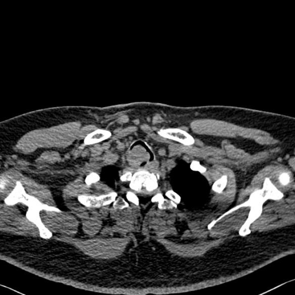 Adenoid cystic carcinoma of the trachea (Radiopaedia 49042-54137 Axial non-contrast 25).jpg
