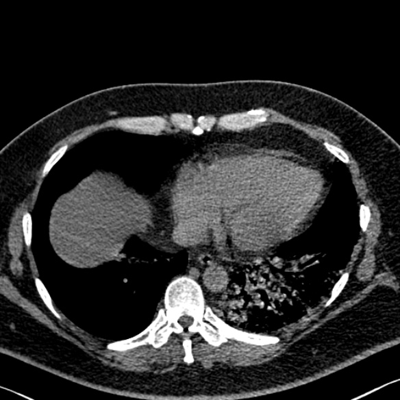 Adenoid cystic carcinoma of the trachea (Radiopaedia 49042-54137 Axial non-contrast 253).jpg