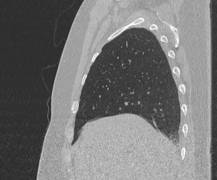 Adenoid cystic carcinoma of the trachea (Radiopaedia 49042-54137 Sagittal lung window 103).jpg