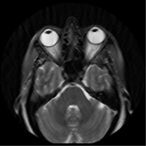 File:Adenoid cystic tumor of palate (Radiopaedia 46980-51519 Axial T2 30).png