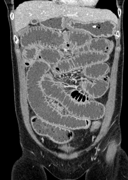 Adhesional small bowel obstruction (Radiopaedia 48397-53305 Coronal C+ portal venous phase 103).jpg