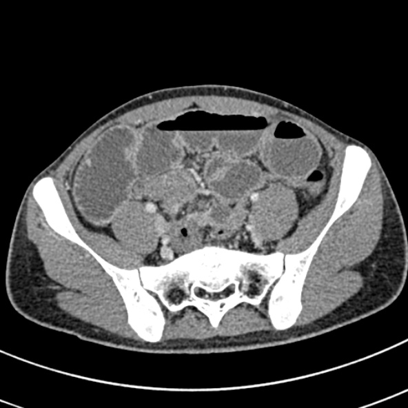 Adhesional small bowel obstruction (Radiopaedia 52107-57980 Axial C+ portal venous phase 95).jpg