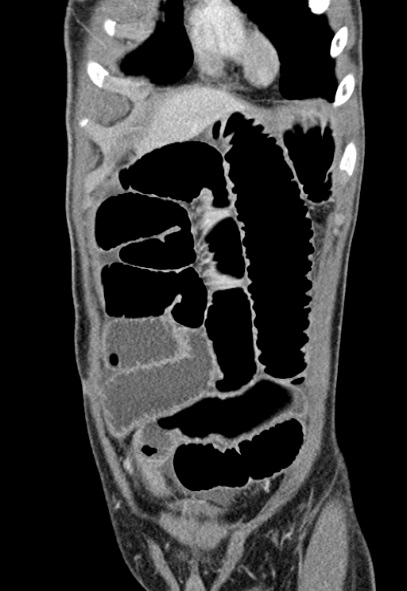 Adhesional small bowel obstruction (Radiopaedia 52107-57980 Coronal C+ portal venous phase 14).jpg
